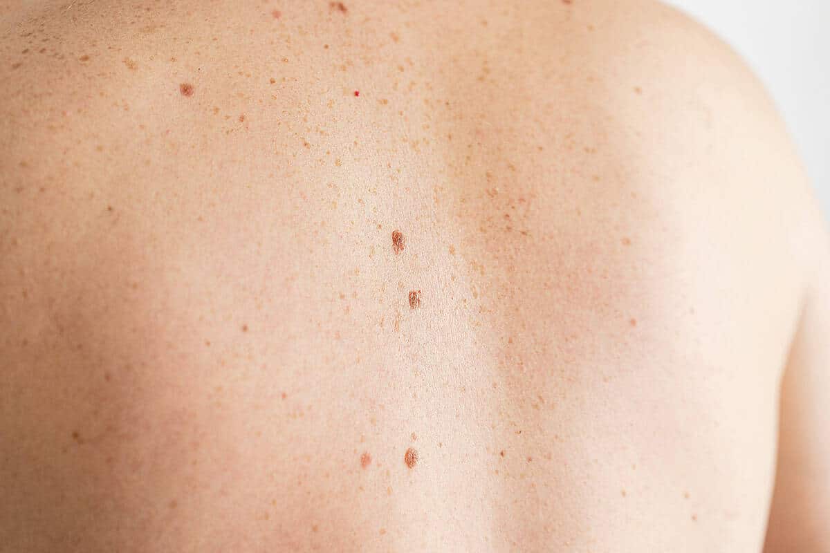 Photo du dos d'une personne. La peau est blanche, avec quelques grains de beauté visibles.